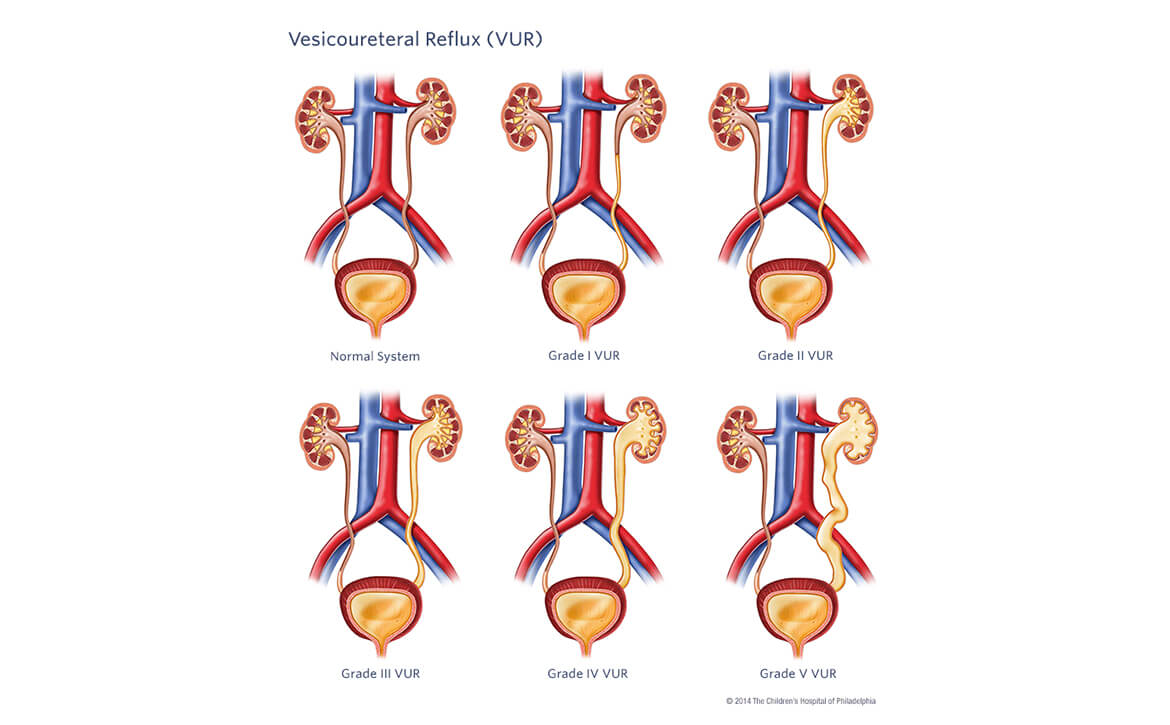 Vesicoureteral Reflux Treatment, Vesicoureteral Reflux Surgery 